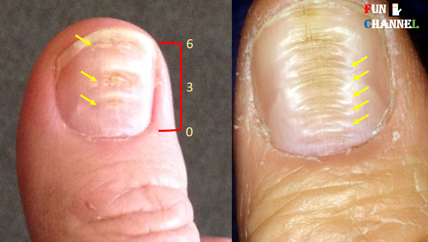 Horizontal Ridges On Toenails Causes Symptoms Prevention Remedies 